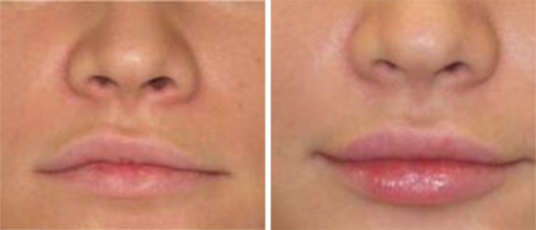 Lip Enhancement Kysse Beautiful/Affordable | Get Hair Less