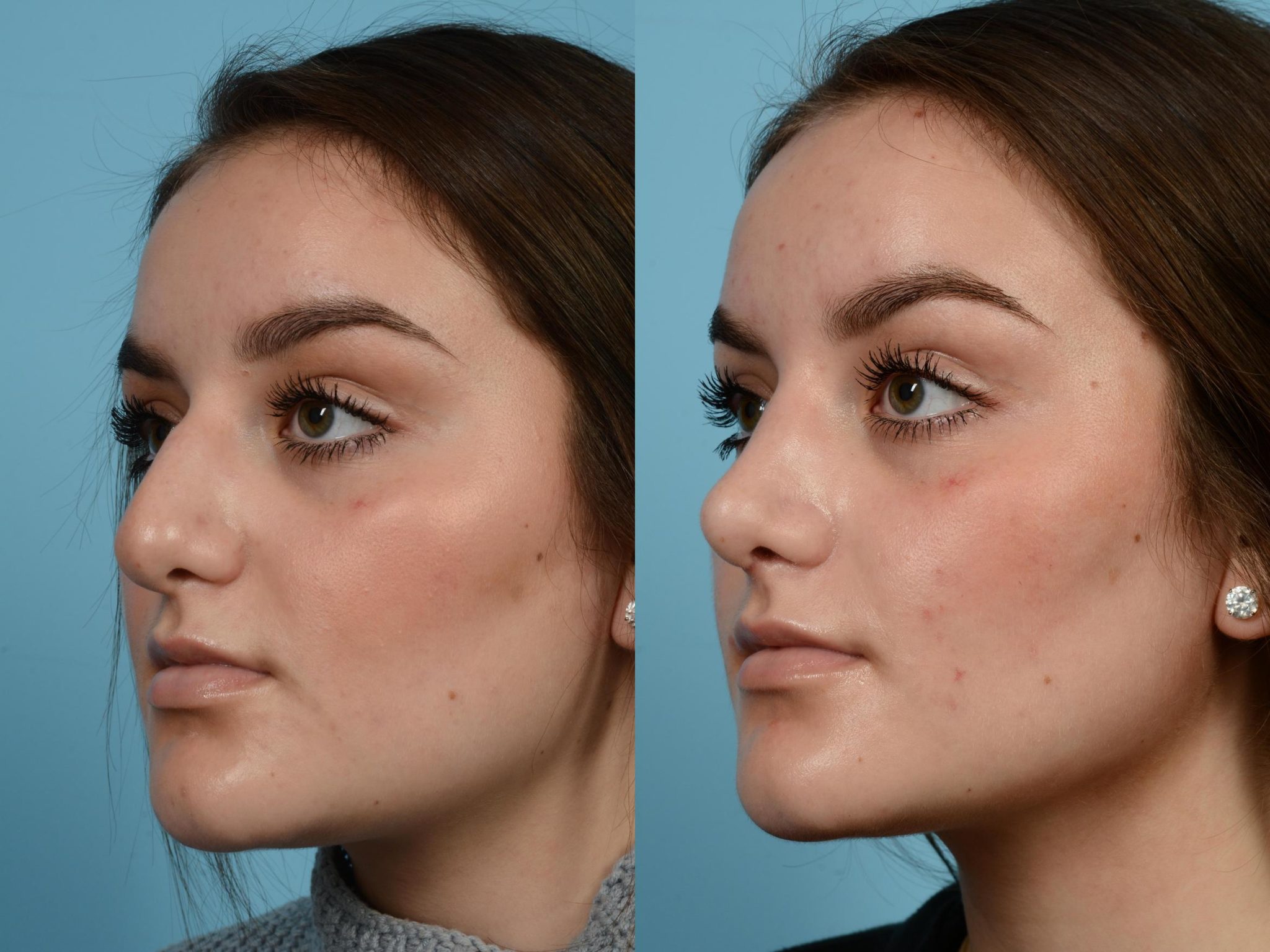 liquid-nose-job-lift-immediate-results-no-more-nose-bumps